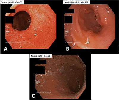 Apoptotic Gastritis in Melanoma Patients Treated With PD-1-Based Immune Checkpoint Inhibition – Clinical and Histopathological Findings Including the Diagnostic Value of Anti-Caspase-3 Immunohistochemistry